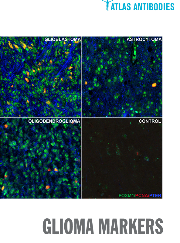 Atlas Antibodies Glioma Markers