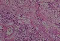 Metastatic cancer to ovary