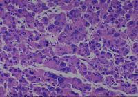 Liver cancer-metastasis-normal