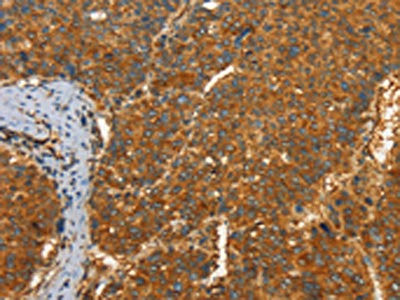 Anti-PFKFB1