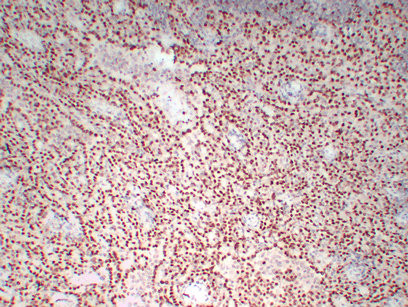 Anti-WT1 / Wilms tumor 1