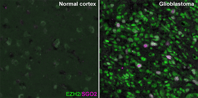 Atlas-Glioma-markers-EZH2-SGO2