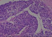 Esophagus cancer