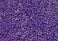 Uterine cervix cancer-metastasis-normal