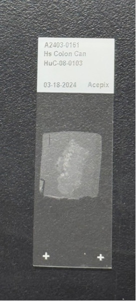 Human FFPE Rhabdomyosarcoma Cancer Tissue Slide (5-PK)