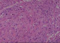 Lung cancer-metastasis-normal