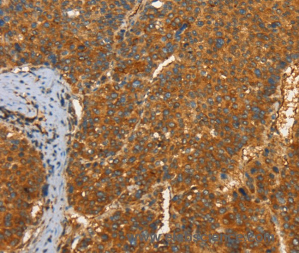 Anti-PFKFB1