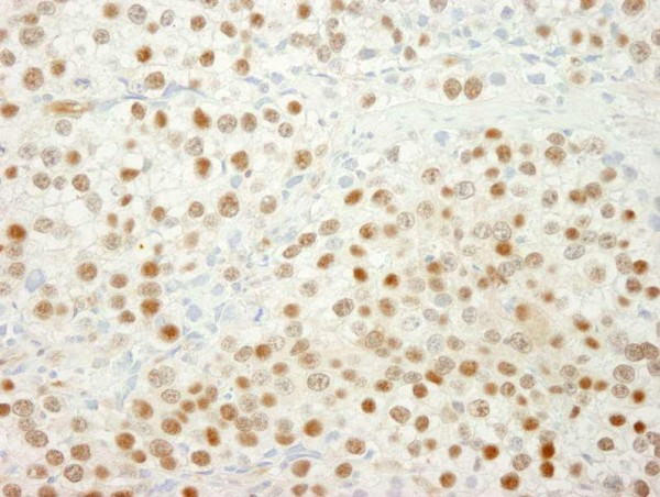 Anti-MSH6 (IHC)