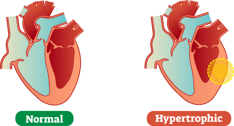 Hypertrophic-vs-Normal-Heart